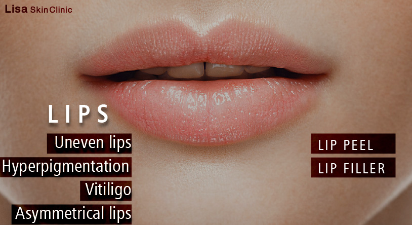 Lip rejuvenation using skin quality injectables at kerala's best aesthetic centre in calicut by board certified dermatologist certified by A4M - American Academy of Anti-Aging Medicine
